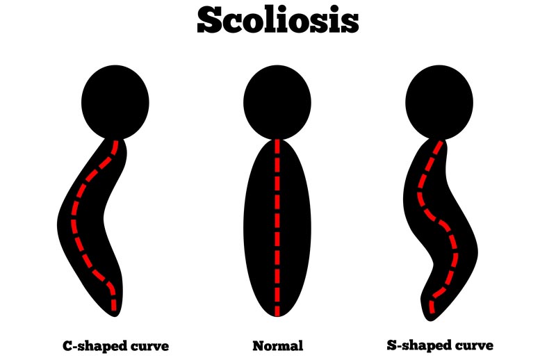 Hoboken, New Jersey scoliosis treatment
